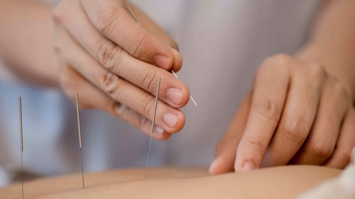 Acupuncture